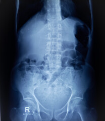 Plain X-ray of Abdomen in erect posture. Large bowel loops are distended with gas and loaded faecal matters. - obrazy, fototapety, plakaty