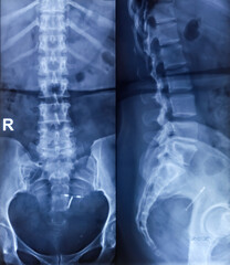 Lumbosacral spine x-ray both view. Lumber spondylosis. Straightining of lumber lordotic curvature, scoliosis having leftward convexity. marginal osteophytes.