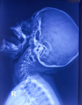 X-ray of nasopharynx lateral view show Enlarged adenoid. Small lobulated dense homogeneous opacity having convex anterior margin. Hicrontrast BW adjust.