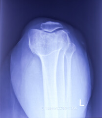 X-ray of Knee joint Skyline view. Osteoarthritis (OA) knee. Degenerative osteoarthritis at left...