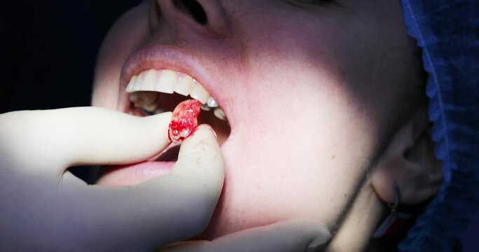 Dentist extract tooth in mouth of woman in dental clinic, close up