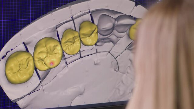 A program on a computer display used by a female dental technician for prosthetic teeth. Program for the design of prosthetic teeth for treatment.