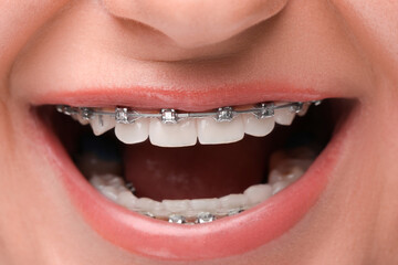 Obraz premium Happy woman with dental braces, closeup view
