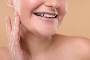 Smiling woman with dental braces on beige background, closeup