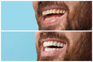 Man showing teeth before and after whitening on light blue background, collage