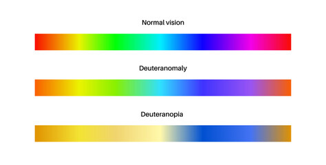 Deuteranomaly and deuteranopia
