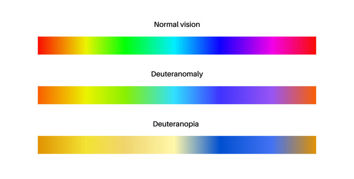 Deuteranomaly and deuteranopia