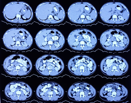 CT scan of HBS and Pancreas (Contrast): Solitary, non enhancing, hypodense lesion having ill defined margin noted. Atypical hemangioma or vascular malformation or mitotic lesion.
