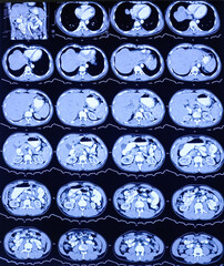 CT scan of HBS and Pancreas (Contrast): Solitary, non enhancing, hypodense lesion having ill...