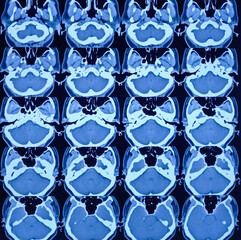 CT scan of the temporal bones showing picture suggestive of bilateral chronic mastoiditis with...