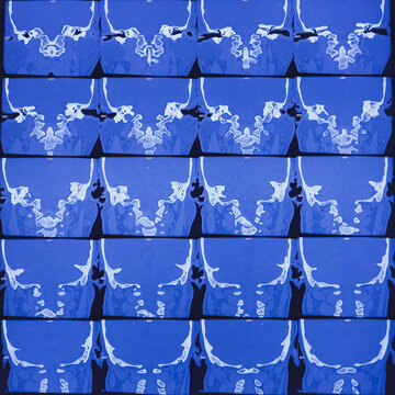 CT scan of the temporal bones showing picture suggestive of bilateral chronic mastoiditis with otitis media. Mastoid air cells are reduced on both side. Mucosal thickening also noted.