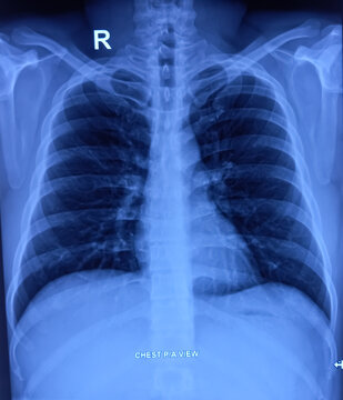 CXR PA view. Chest X-ray rediograph. PA view. Normal findings.