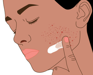 Acne or pustule on tan women's face used skin care treatment, illustration on white background