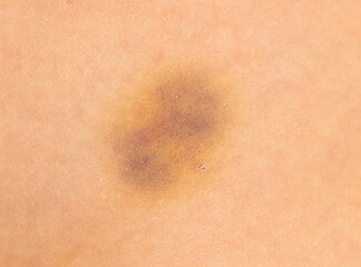 Close-up of a bruise on a person's skin