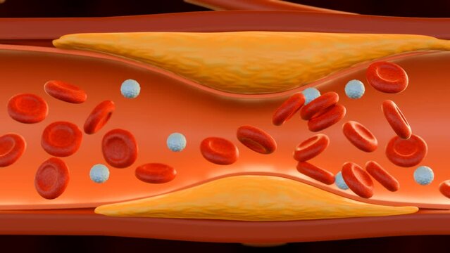 3d animation of flowing blood through plaque formation of Cholesterol in artery (atherosclerosis)