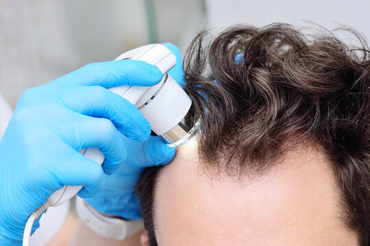 Close-up cosmetologist trichologist diagnoses the condition of the hair of a male patient with baldness using trichoscopy.