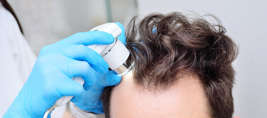Close-up cosmetologist trichologist diagnoses the condition of the hair of a male patient with baldness using trichoscopy.