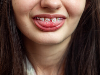 Obraz premium Teenager girl with pink color braces. Dentist procedure to straighten up teeth for better appearance and functionality. Health and psychology problem solution. Selective focus. High cost service