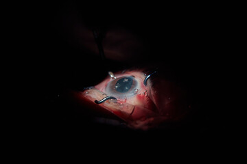 Phacoemulsification, destruction of the opaque lens by ultrasound, ophthalmic eye surgery. eye lens...