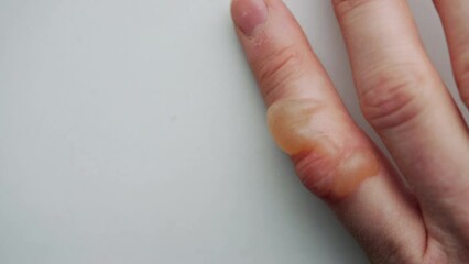 A large blister on a finger from a thermal burn. Redness on the skin from a burn, close-up