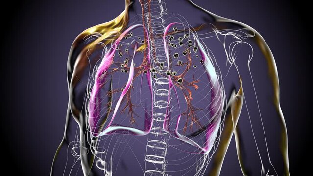 Medical 3D animation depicting lungs affected by silicosis within a transparent human body, revealing dark silicotic nodules, emphasizing respiratory health issues due to silica exposure.