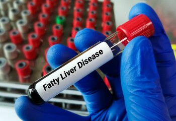 Blood sample for Fatty liver disease test. Liver enzyme test, LFT, Medical concept. FIB-4 or APRI,...