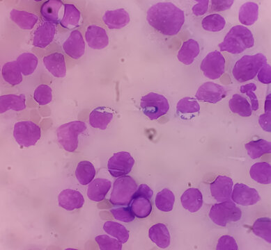Acute myeloid leukemia (AML). Smear show shift maturation of then are blast cells, low N : C ratio, abundant cytoplasm, loose chromatin and prominent nucleoli. Thrombocytopenia.