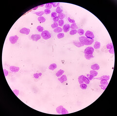 Acute myeloid leukemia (AML). Smear show shift maturation of then are blast cells, low N : C ratio,...