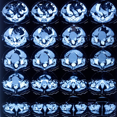 Metastatic adenocarcinoma patient. CT scan of whole abdumen. Acalculus cholecystitis. Circumferential chickening of wall of jejunum-ileum and ascending colon. enteritis, colitis.