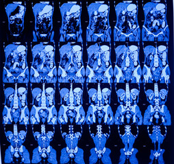 Cervix carcinoma. CT scan of cervix of uterus. Cu-T noted in situ in uterine cavity. Soft tissue...