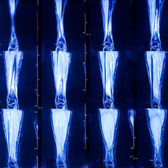 MRI (Magnetic resonance imaging) scan of leg. Lytic bony lesion at tibia with adjacent long segment...