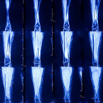 MRI (Magnetic resonance imaging) scan of leg. Lytic bony lesion at tibia with adjacent long segment intra-medullary abnormal marrow signal intensity lesion. Chronic osteomyelitis. Tubercular lesion.