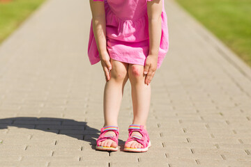 Toddler girl standing on sidewalk at city park and showing abrasion knee skin in summer day. Child...