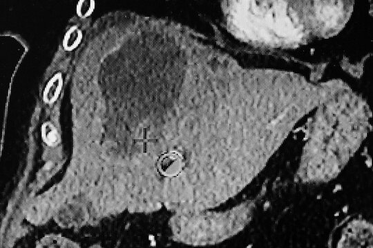 Cat Scan of amoebic liver abscess. Medical themes