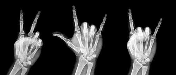 Film xray x-ray or radiograph of a hand and fingers showing the peace hippie 1960s groovy sign or V, I love you, rock on devil horn.  aka peace, love and rock n roll.  isolated on white background - obrazy, fototapety, plakaty