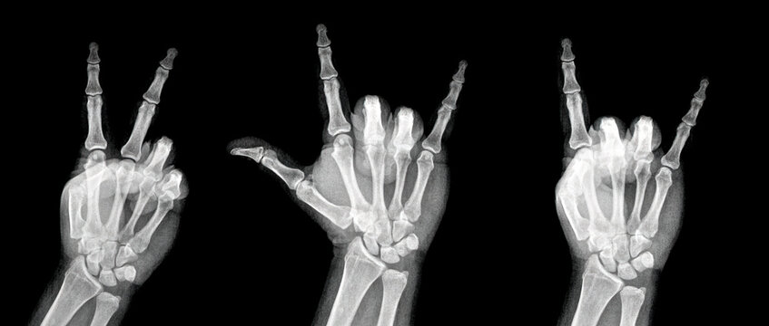 Film xray x-ray or radiograph of a hand and fingers showing the peace hippie 1960s groovy sign or V, I love you, rock on devil horn.  aka peace, love and rock n roll.  isolated on white background