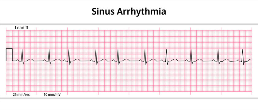 ECG Sinus Arrhythmia - 8 Second ECG Paper - Electrocardiogram Vector Medical Illustration