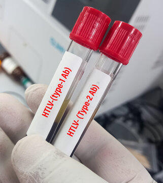 Blood sample for Human T-lymphotropic virus or Human T-cell leukaemia virus or HLTV type 1 test, to diagnose a type of cancer called adult T-cell leukaemia or Lymphoma.
