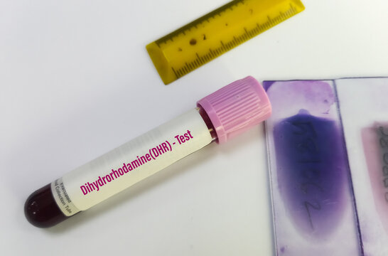 Blood sample for DHR (Dihydrorhodamine) or Neutrophil Function Test for the diagnosis of chronic granulomatous disease (CGD). Phagocytic leukocytes.