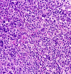 Non-Hodgkin lymphoma(Trephine biopsy tissue). Microscopically show hypercellular cell, megakaryocytes, granulopoiesis with atypical lymphocytic population of cells.
