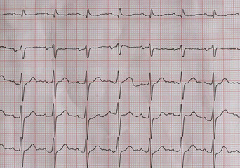 EKG heart beat, electrocardiogram results