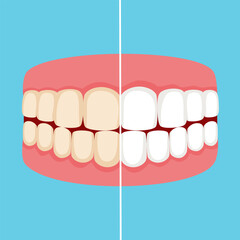 Teeth whitening and bleaching concept. Dentistry and stomatology vector.