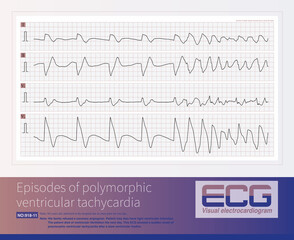 Male, 84 years old, admitted to hospital with chest pain for 1 day. ECG showed acute inferior and posterior MI and possibly right MI. The patient died of ventricular fibrillation the next day.