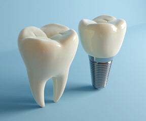 Tooth and implant dental abstract 3D illustration