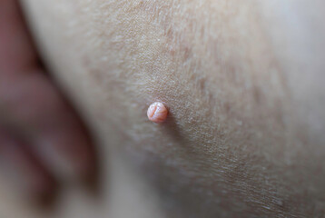Skin tag or acrochordon or soft fibroma or mole. macro photo. Papilloma virus or bump, dermatology problem on skin concept.