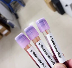 Blood samples for beta thalassemia test, blood disorder that reduces the production of hemoglobin,...