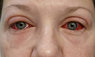 Conjunctivitis - Pink Eyes, Covid-19 Eyes