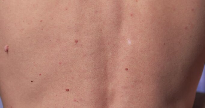 Close-up of Neoplasm or Birthmark on the Skin of an adult male. Pigmented spots on the back of a man. Skin with moles and Acne.