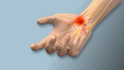  Carpal tunnel syndrome pain, numbness,tingling  - obrazy, fototapety, plakaty