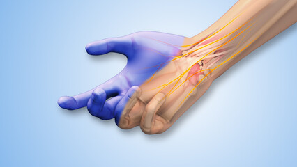 Carpal tunnel syndrome tingling, numbness, and discomfort 